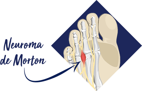 Neuroma de Morton